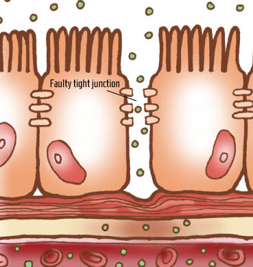 Leaky Gut Syndrome Close Up