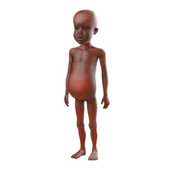 malnourished-african-child-starving